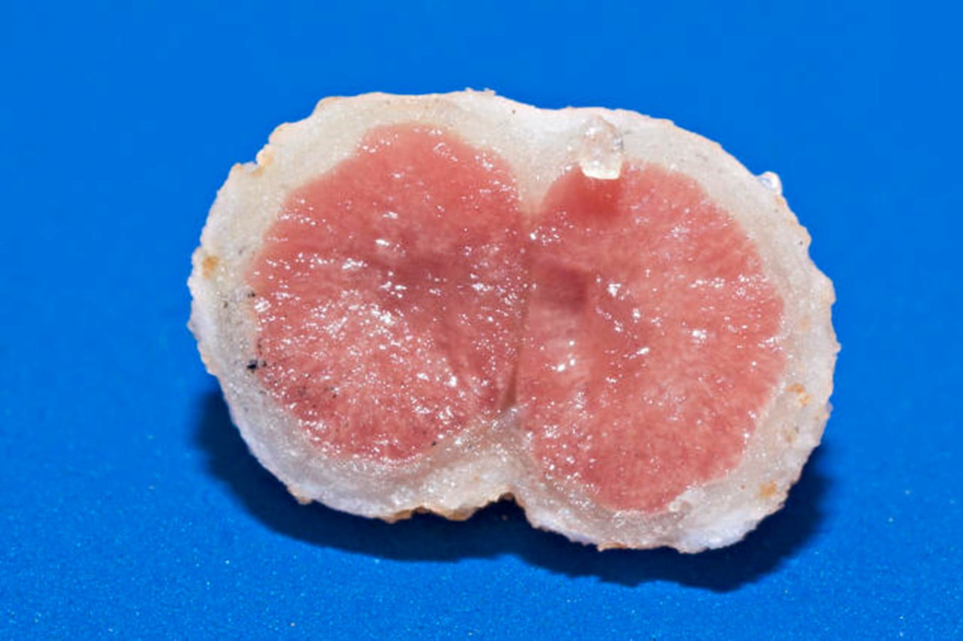 Corte transversal de um nódulo de FBN.